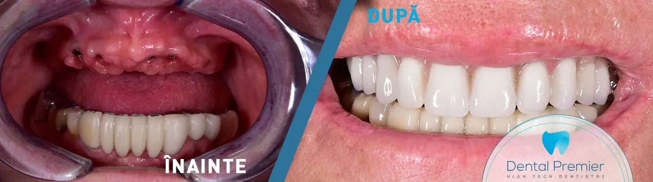 Upper jaw full arch restoration with All-on-6 dental implants