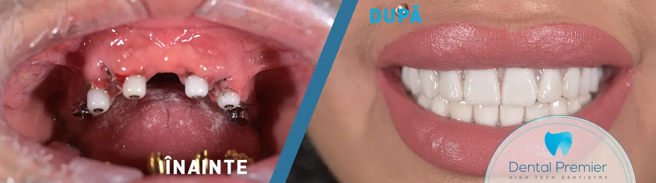 Full mouth restoration with Sky Fast and Fixed same day dental implants