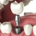 10 motive sa alegi implantul dentar
