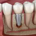 implant dentar nereusit respins