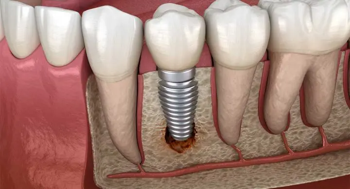 implant dentar nereusit respins