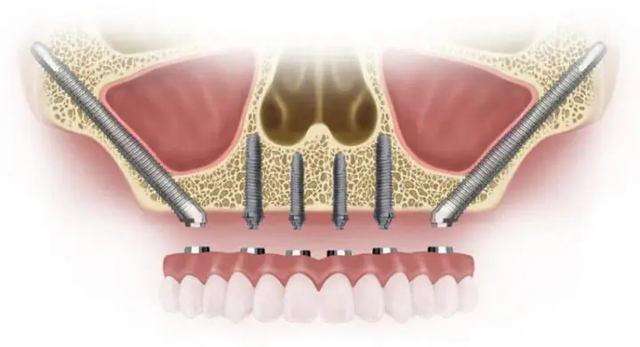 Implanturi dentare zigomatice: indicatii, riscuri, preturi