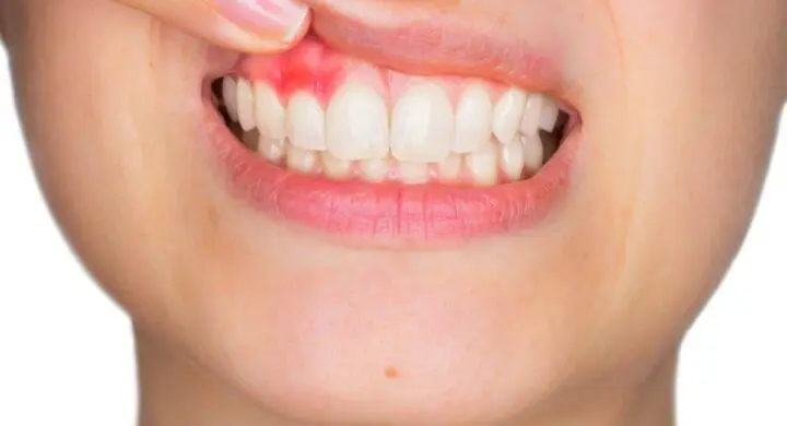 abces dentar