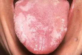 leucoplazie orala limba