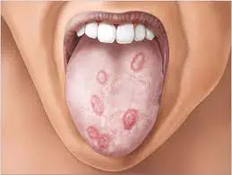 pete albe limba sifilis