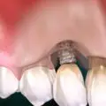 complicatii si riscuri implant dentar