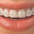 durata montare aparat dentar
