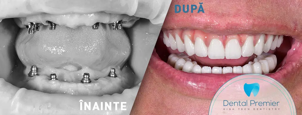 Implanturi All on 6 maxilar + All on 4 mandibula