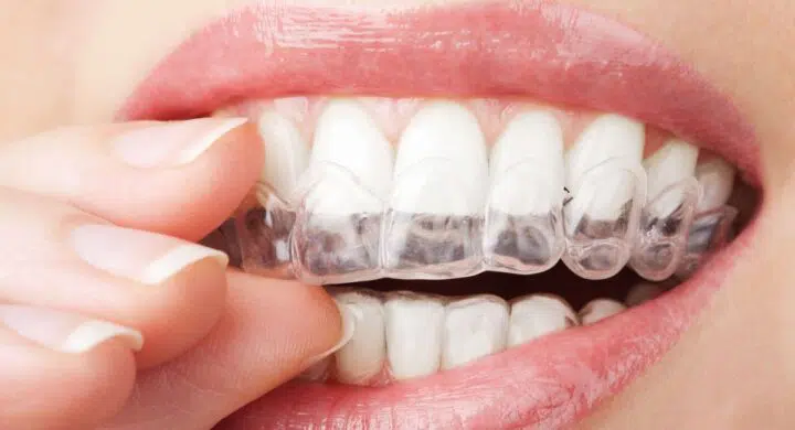 Gutiera dentara: tipuri si preturi