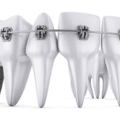 aparat dentar cu implant sau punte dentara