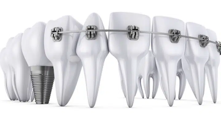 aparat dentar cu implant sau punte dentara