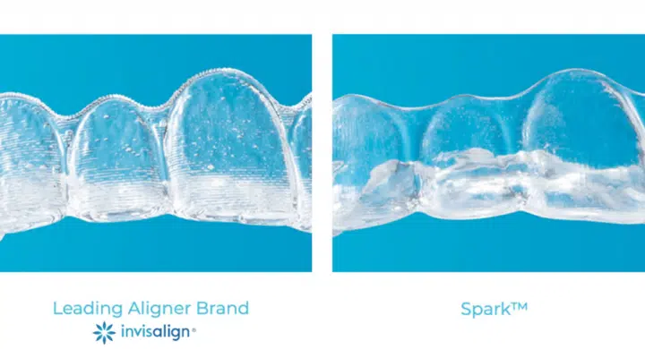 Aparat dentar invizibil Invisalign versus Spark Clear Aligners