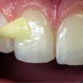 Fluorizare dinti