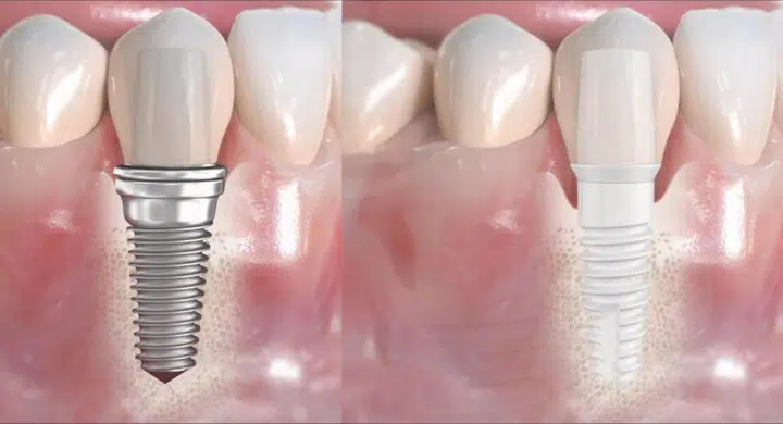 Implant dentar zirconiu versus titan