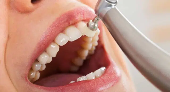 Periaj profesional dentar