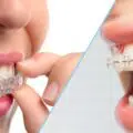 indreptarea dintilor fara aparat dentar
