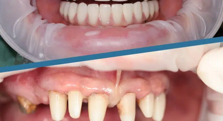 implant dentar total complet pret