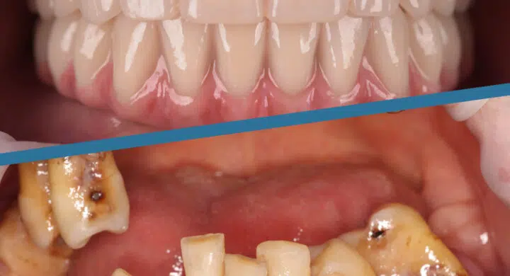 Proteze dentare fixe pe 6 implanturi