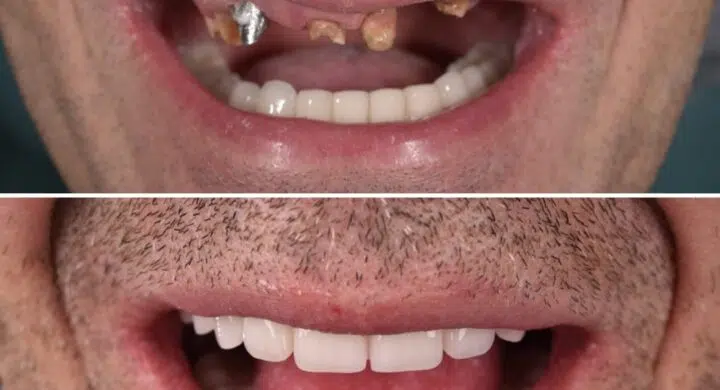 Fast Smile INNO - maxilar si mandibula - lucrari fixe pe 4 si 6 implanturi dentare