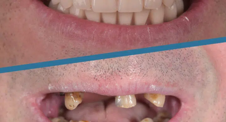 implant dentar complet