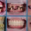 Protetica dentara lucrari dentare