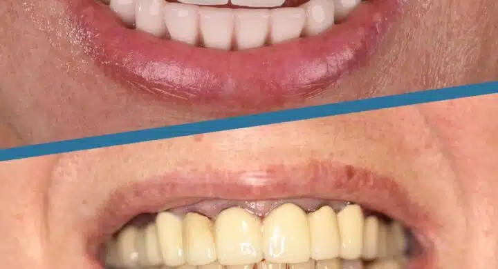 Implant dentar All-on-6 Nobel Biocare