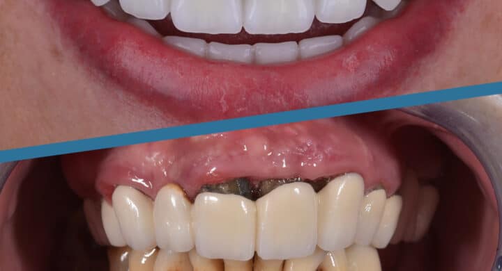 Implant dentar Sky Fast and Fixed Bredent + Fast Smile Inno