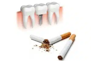 Fumatul afecteaza implantul dentar