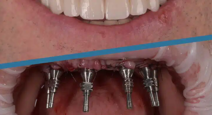 Implant dentar Fast and Fixed - proteza fixa cu 6 implanturi pret