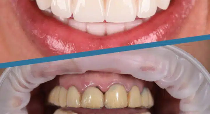 Implant dentar All-on-4 si All-on-6