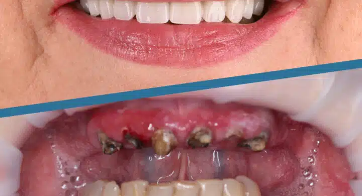 Pacienta 59 ani - implant dentar All-on-6