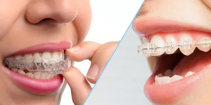 Cel mai bun aparat dentar si ortodont Bucuresti