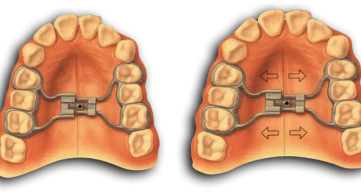 Disjunctor dentar maxilar