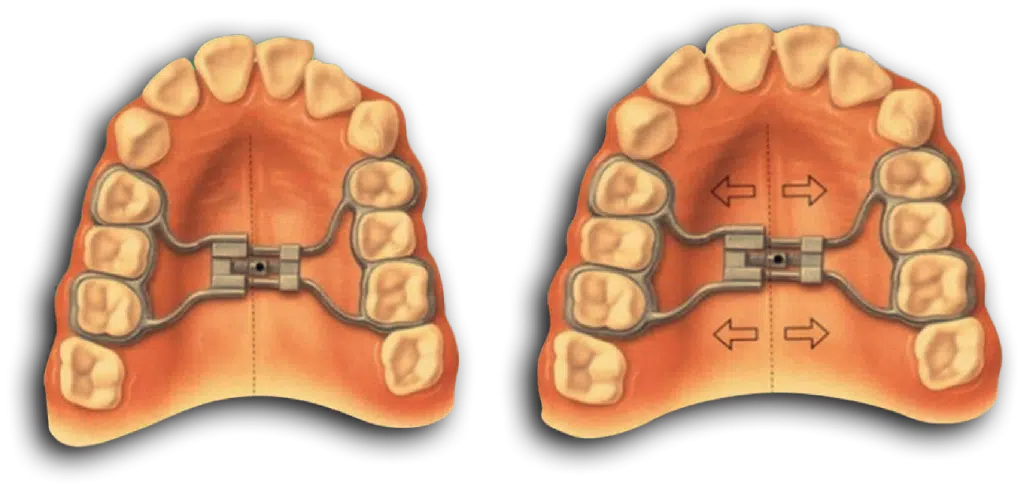 Disjunctor dentar maxilar