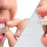 Gutiere dentare sau aparat dentar?