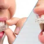 Gutiere dentare sau aparat dentar?