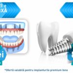 implant masea pret versus cat costa un implant dentar dinte