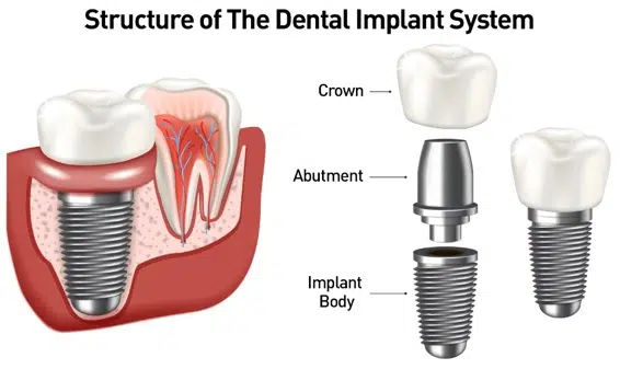 Dental implants structure