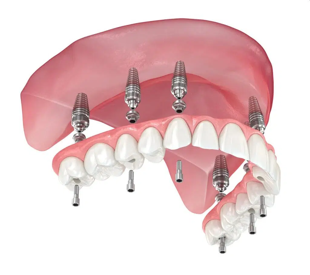 Full mouth rehabilitation with same day dental implants