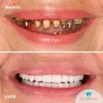 implant dentaire mâchoire bouche complète All-on-6