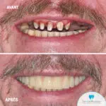 Dentier fixe complète sur implants dentaires