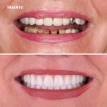 Proteze dentara fixe cu 6 implanturi Megagen All-on-6