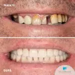 Maxilar si mandibula - implanturi Bredent si coroane dentare